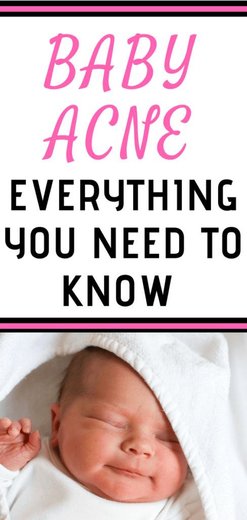 Find out everything you need to know about what causes baby acne and how to treat it. Which baby acne remedies work and which ones to avoid. Simple ways to treat this common newborn skin issue. 